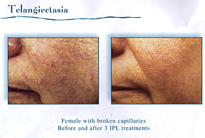 Chicago Laser Skin Rejuvenation